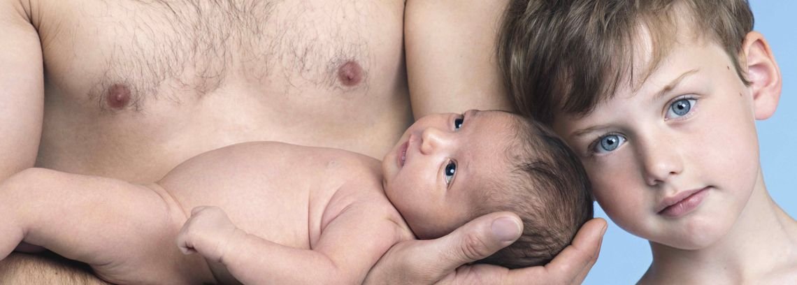 eczema