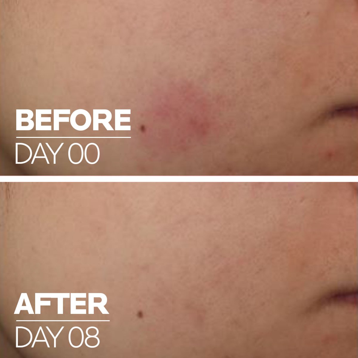 lrp_skbc_cicaplast_vitaminb5_beforeafter