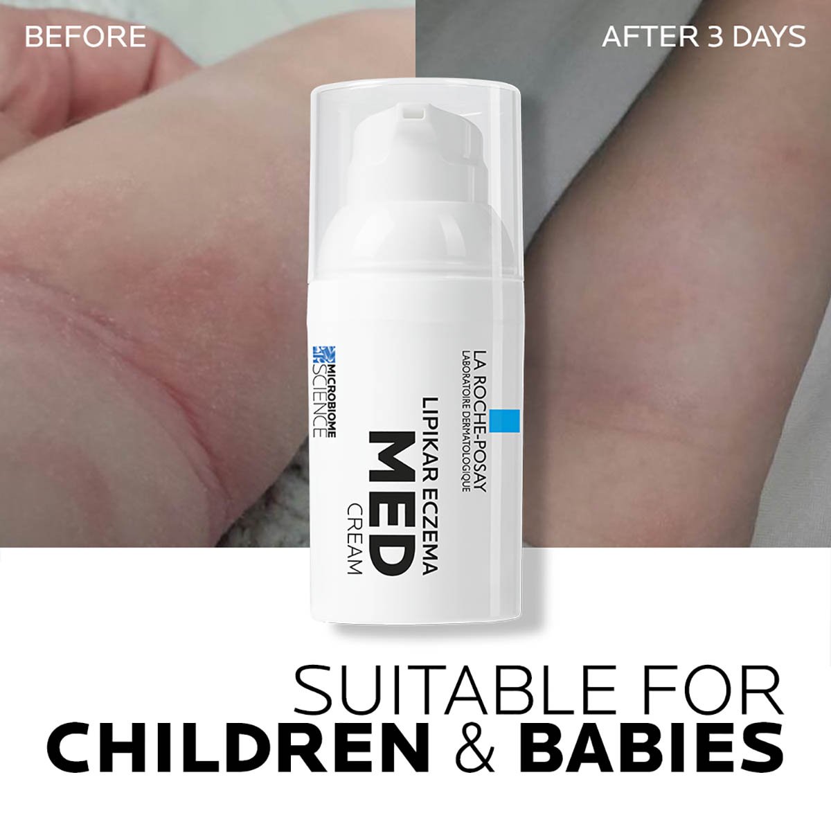 lrp-lipikar-eczema-med-3337875771214-Beforeafter1